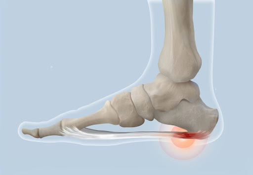 Radiation for plantar fasciitis, Lawrence , KS 2024